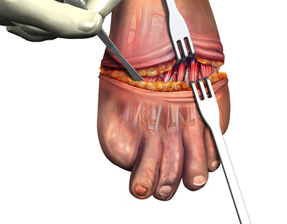 Transmetatarsal Amputation of Foot
