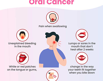 Detecting Oral Cancer: What You Need to Know