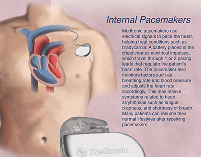 Medtronic Pacemaker Advertisement