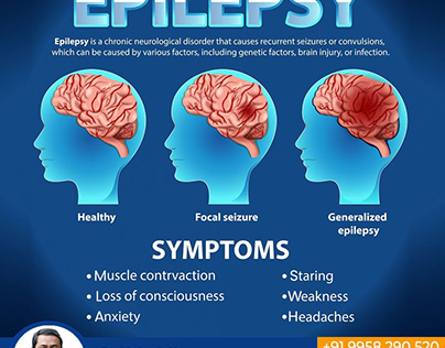 Understanding Epilepsy: Causes, Symptoms