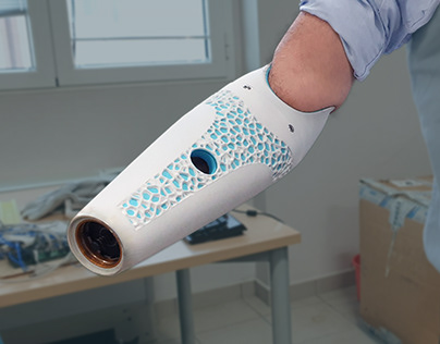 D-Pulp, digital process for upper limb prosthetics