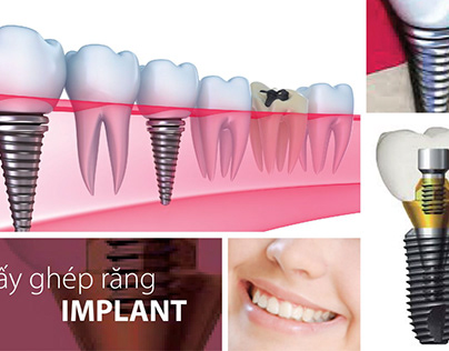 Thời gian trồng răng implant mất bao lâu ?