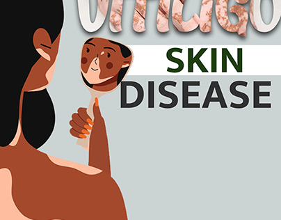 Vitiligo isn't a flaw; it's a masterpiece in progress.