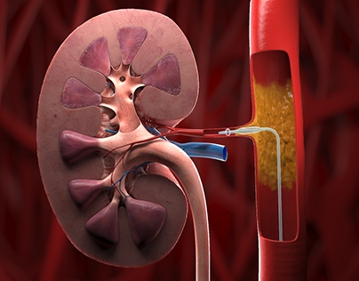Kidney and catheter