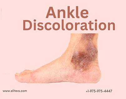 Ankle Discoloration