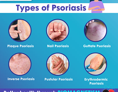 Exploring Psoriasis Types and Biomagnetism Therapy: