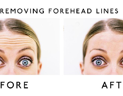 Removing forehead lines