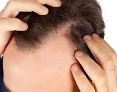How To Regrow Lost Hair Naturally In 10 Days?