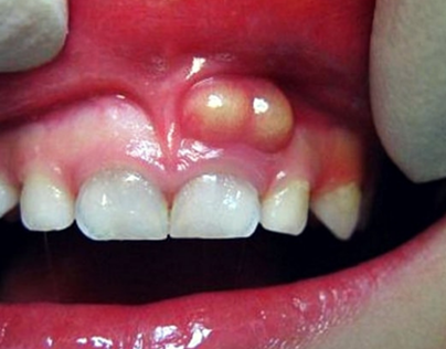 Gum Boils: What They Are and How to Treat Them