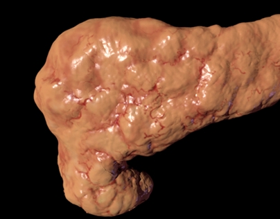 3D Pancreas