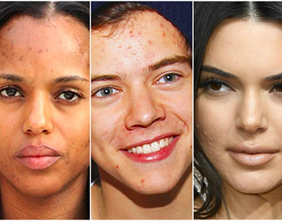 acne removing in Photoshop
