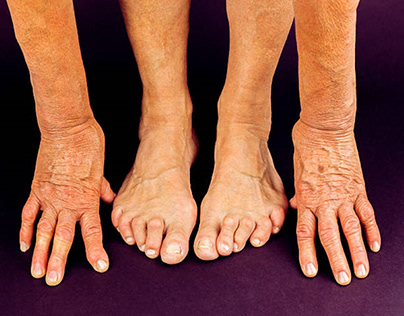 Are you having childhood foot deformity or Foot drop