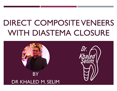 2 Centrals direct composite veneers & diastema closure