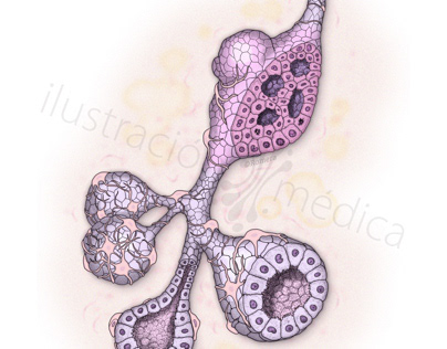 Carcinoma ductal de mama, arquitectura histológica