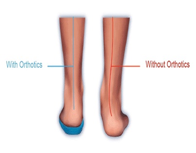 What is the Primary Use of Custom-Made Foot Orthotics?