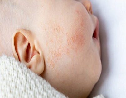 Preventing Heat Rashes in Infants and Toddlers