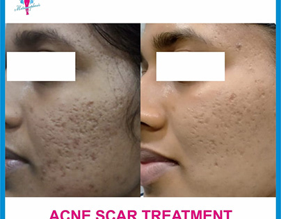 Say Goodbye To Acne Scars with The Expert Skin