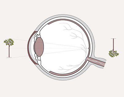 Comment voit un myope ?