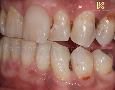 RCT&composite rest. for tooth no.23