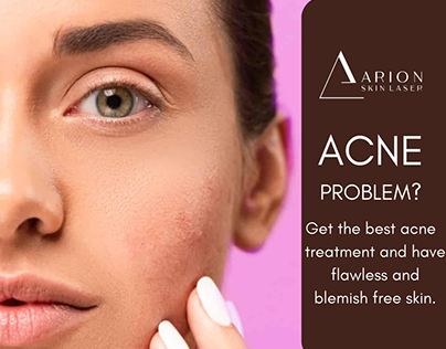 Popular acne and blemishes treatments
