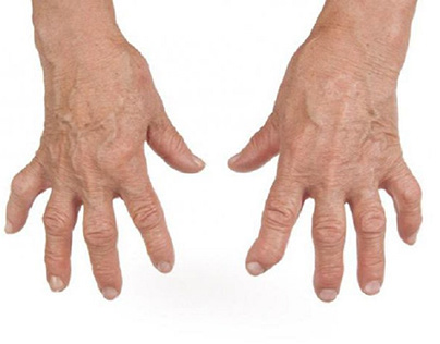 Rheumatoid arthritis treatment with injection