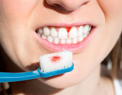 18 Reasons for Gum Bleeding While Brushing -Oris Dental