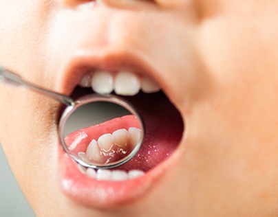 Understanding Cavities: Types, Causes, and Prevention