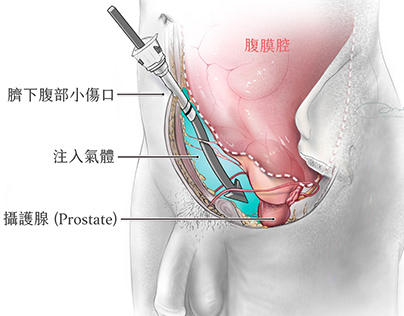 Extraperitoneal radical prostatectomy