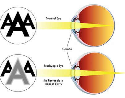 An Overview of Presbyopia