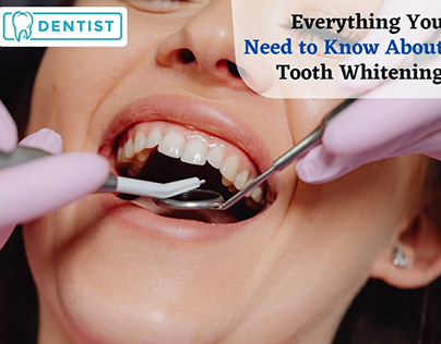 Everything You Need to Know About Tooth Whitening