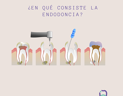 ¿En qué consiste la Endodoncia?