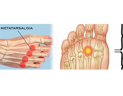 Relieving Metatarsalgia Pain with Orthotics