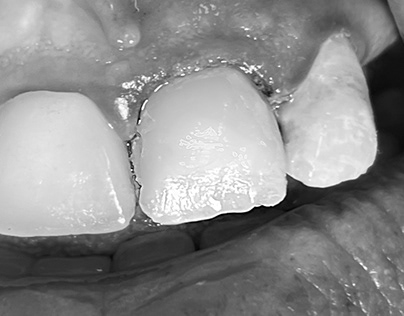 Composite in decayed anterior central tooth