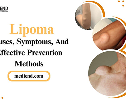Lipoma Causes, Symptoms, Effective Prevention Methods
