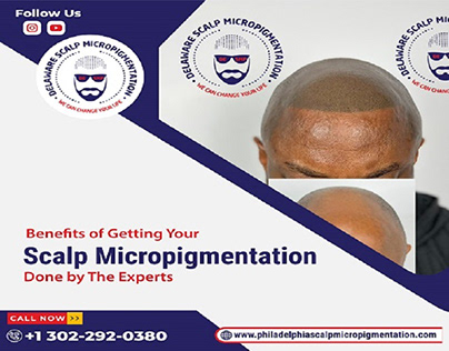Benefits of Getting Your Scalp Micropigmentation