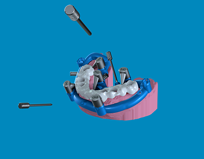 LET'S TALK GUIDED | 3D Dental Implant Animation