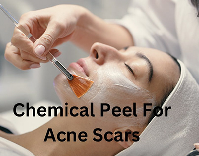 Using Chemical Peels for Treating Acne Scars