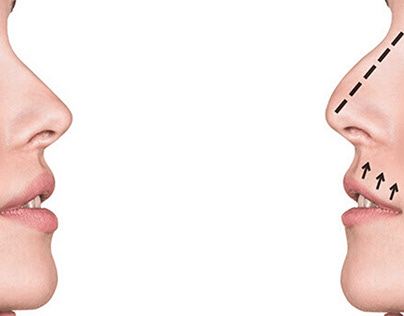 Options for Nose Surgery at Drdateclinic in India