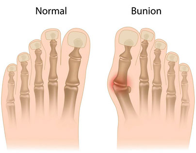 How to Get Rid of Bunions?