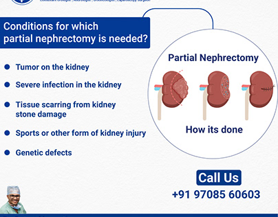 Partial Nephrectomy surgery - Dr. Saket Narnoli