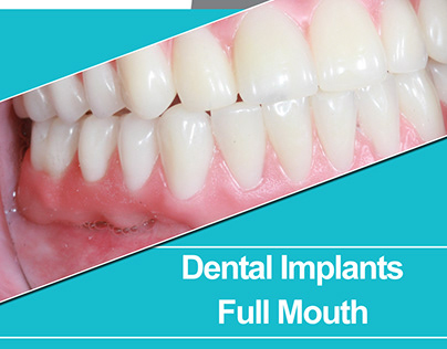 Dentist Implants Hamilton