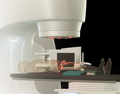 LINAC Prostate Cancer