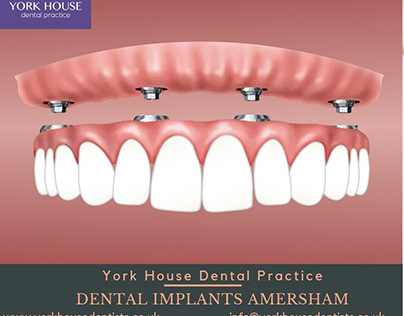 Dental Implants Amersham