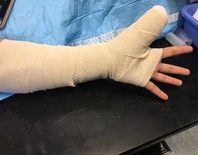Thumb spica cast/ splints
