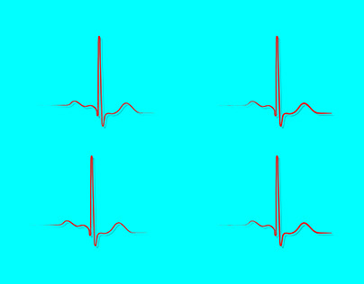 Ventricular repolarization, Cardiac cycle, ECG of heart