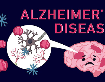 The Silent Thief: Understanding Alzheimer's Disease