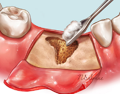 Dental Grafting. Medical illustration