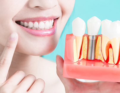 Stunning Dental Implant Results