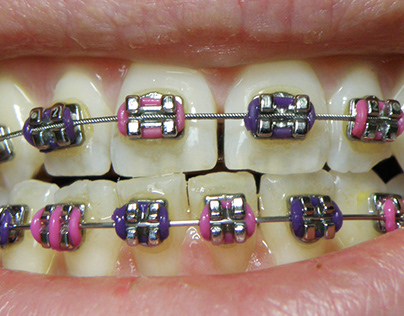 What Exactly Are Clear Braces?