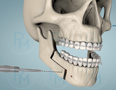 Orthognathic Surgery 3D animation